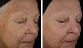 Jean D'arcel Multi-Molecular Hyaluronic and plant StemCells Complex - RESULT 3